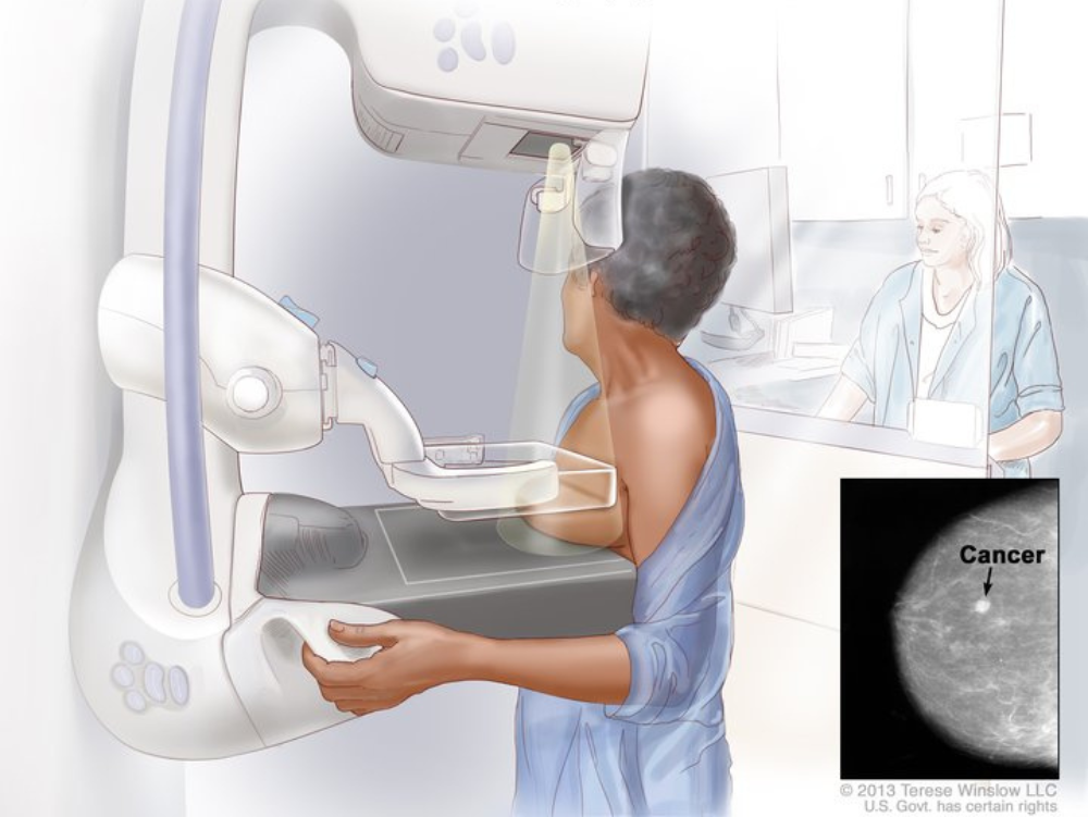 Mamografía